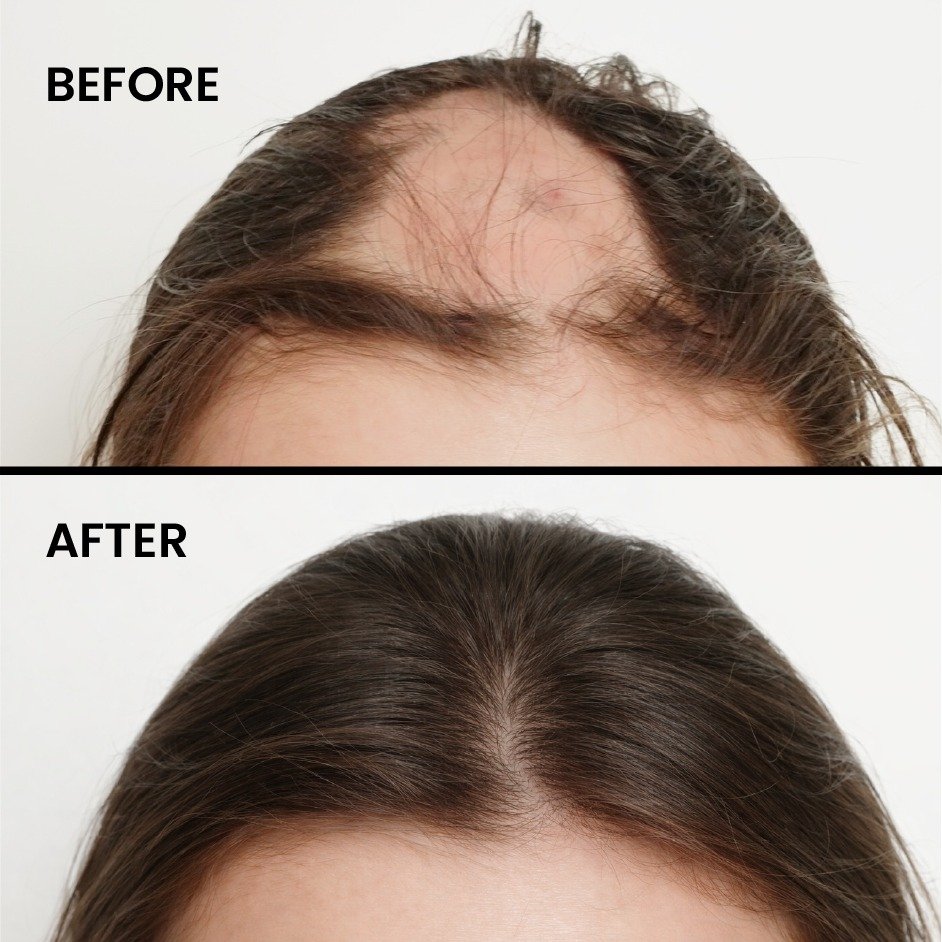Alopecia Hair Loss Treatment Before After Results at Shanti Skin and Laser Center Ranchi