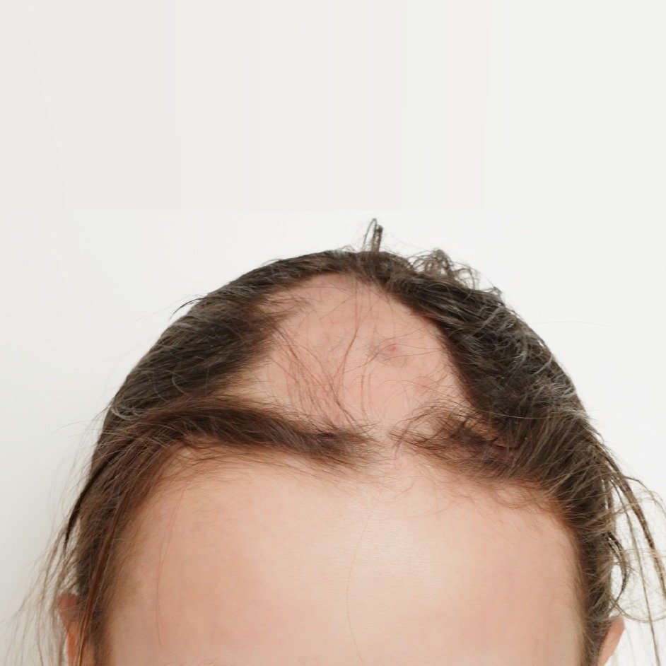 Alopecia Areata Regrowth Before After - 6 Months Steroid Injection Treatment Ranchi