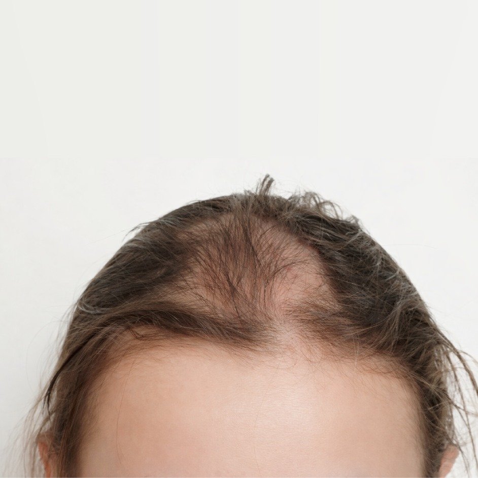 Pattern Baldness Improvement Before After - 8 Months PRP and Minoxidil Treatment