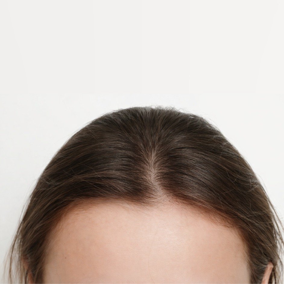 Female Hair Loss Recovery Before After - 5 Months Combination Therapy