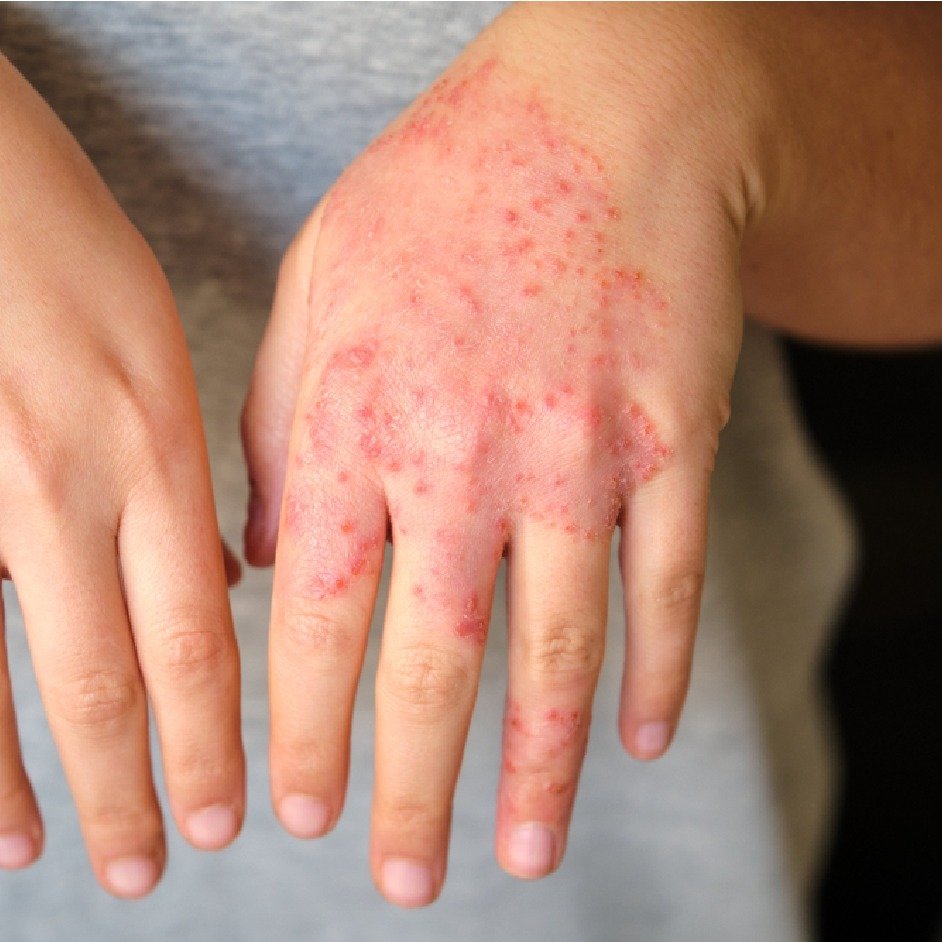 Severe Eczema Relief Before After - 2 Months Treatment Results Ranchi