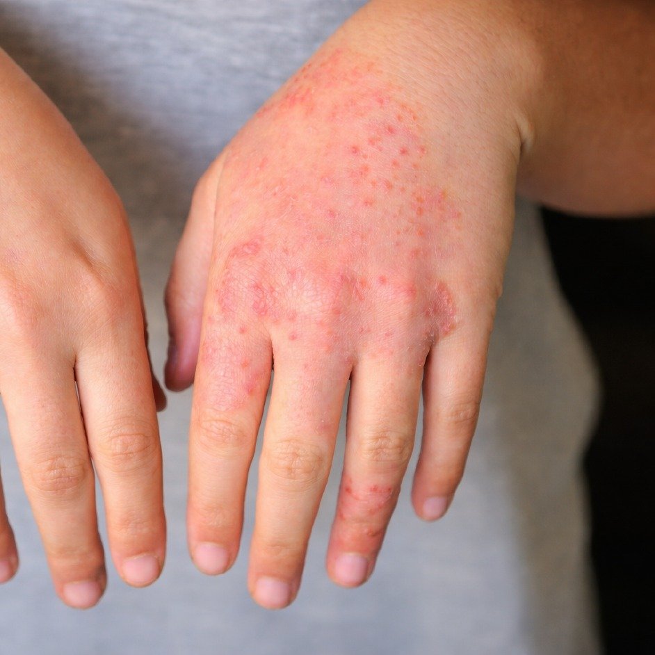 Hand Eczema Treatment Before After - 6 Weeks Results