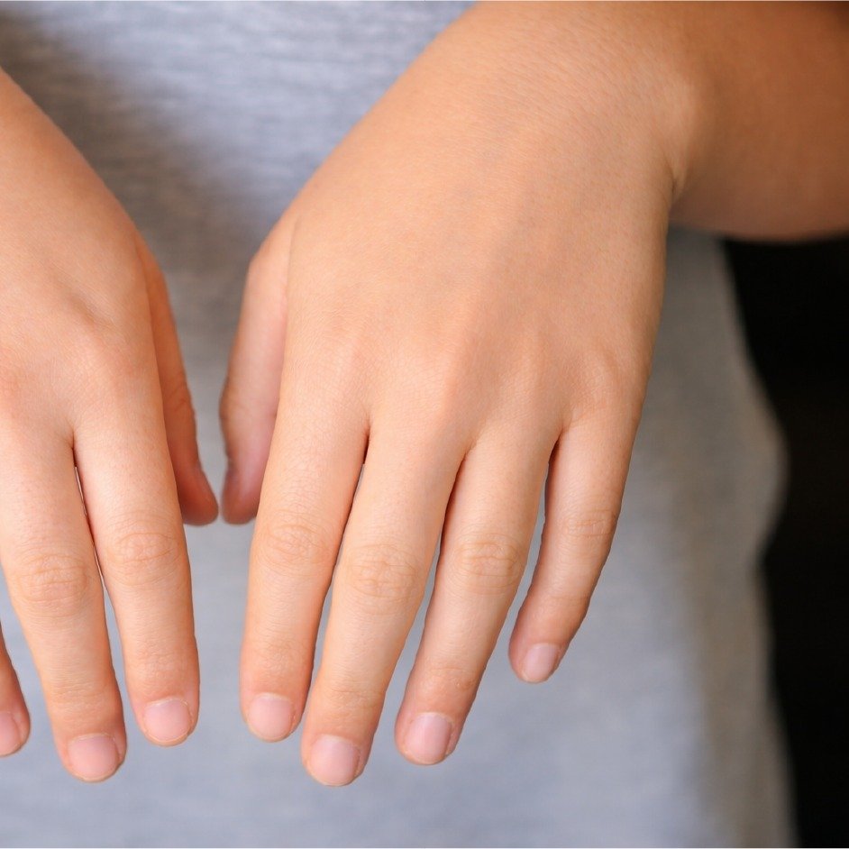 Childhood Eczema Treatment Success - 3 Months Results