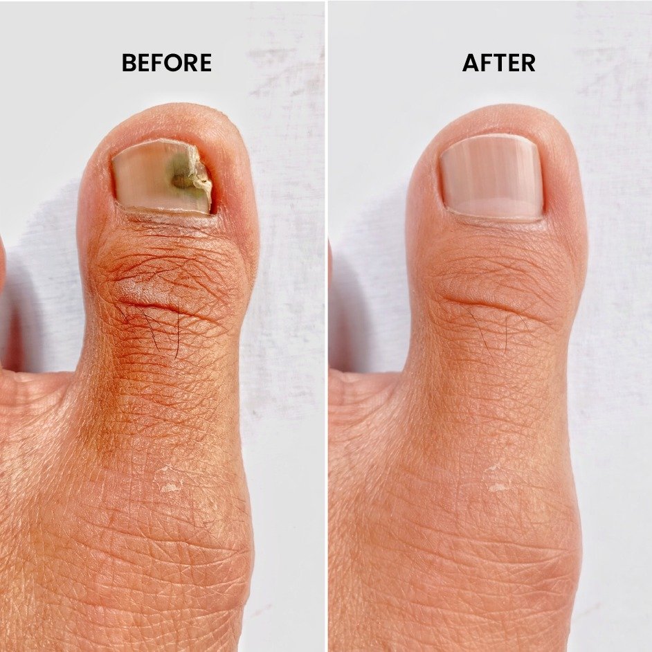 Fungal and Allergy Treatment Before After Results at Shanti Skin and Laser Center Ranchi