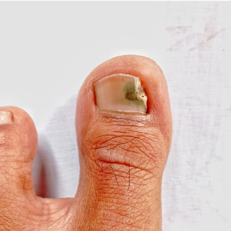 Ringworm Complete Clearance Before After - 4 Weeks Antifungal Treatment Ranchi