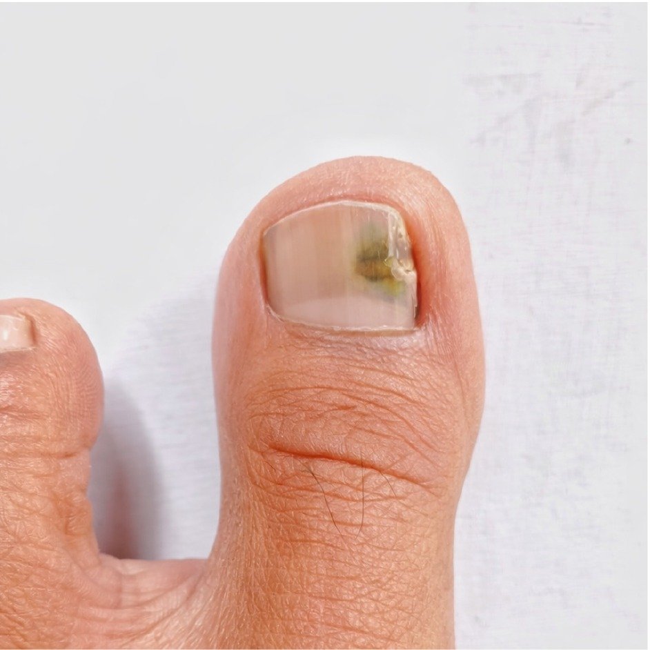 Nail Fungus Recovery Before After - 3 Months Oral Antifungal Treatment