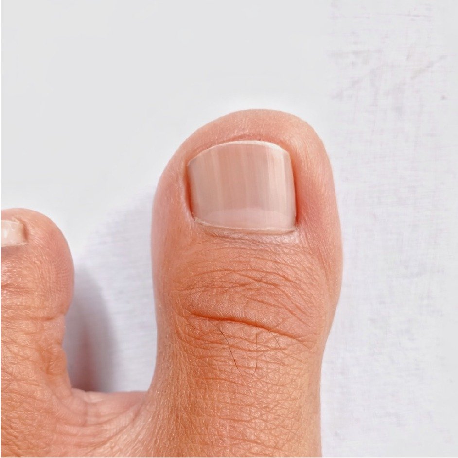 Contact Dermatitis Relief Before After - 2 Weeks Antihistamine Therapy