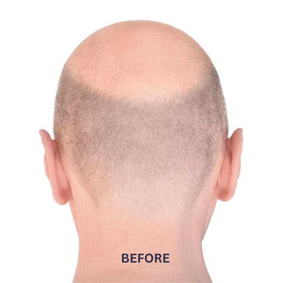 Male Pattern Baldness FUE Hair Transplant Results Before After - 3000 Grafts Ranchi