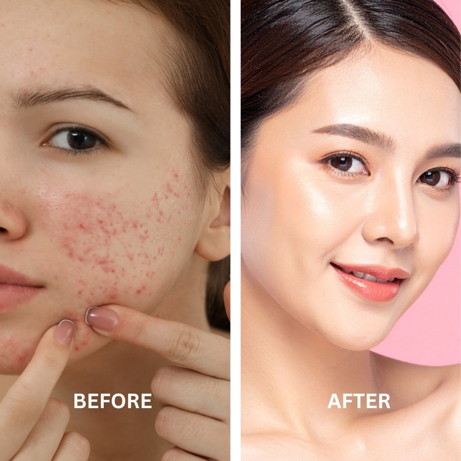 Pimples and Acne Scars Treatment Before After Results at Shanti Skin and Laser Center Ranchi