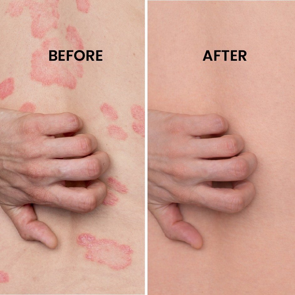 Psoriasis Treatment Before After Results at Shanti Skin and Laser Center Ranchi