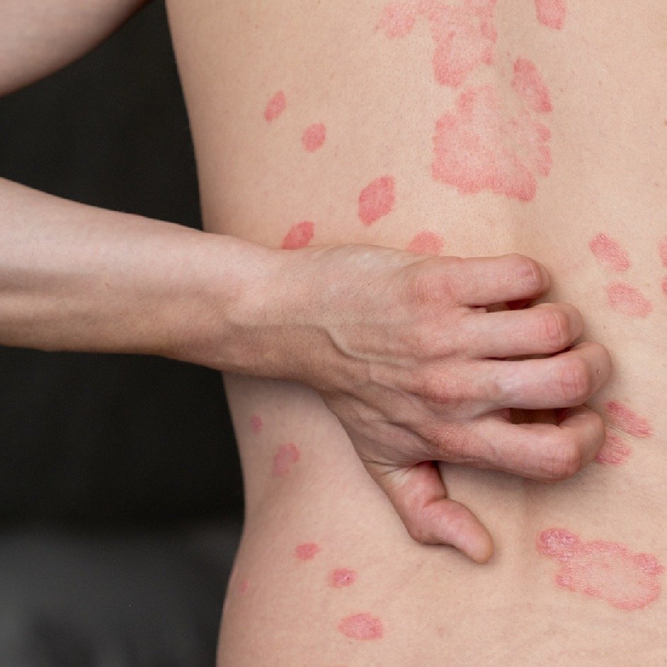 Plaque Psoriasis Clearance Before After - 3 Months Phototherapy Results Ranchi