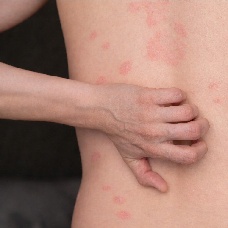 Severe Psoriasis Improvement Before After - 4 Months Biologic Therapy