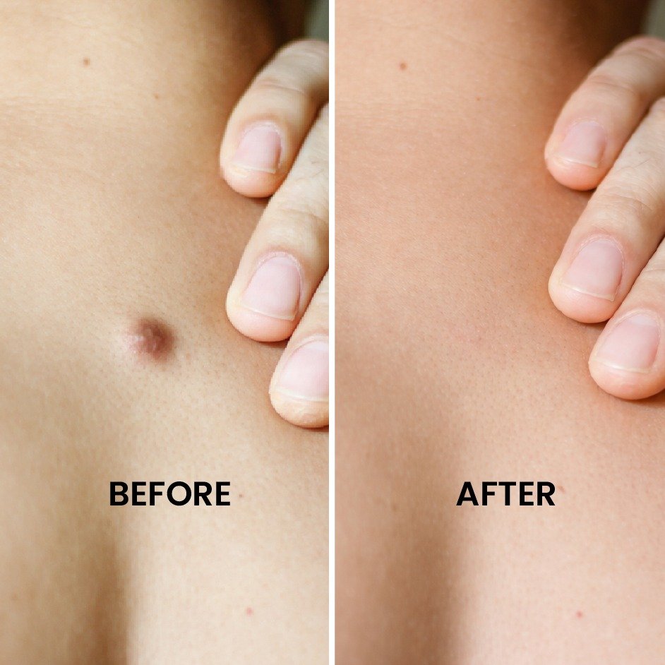 Wart Mole Cyst Removal Before After Results at Shanti Skin and Laser Center Ranchi