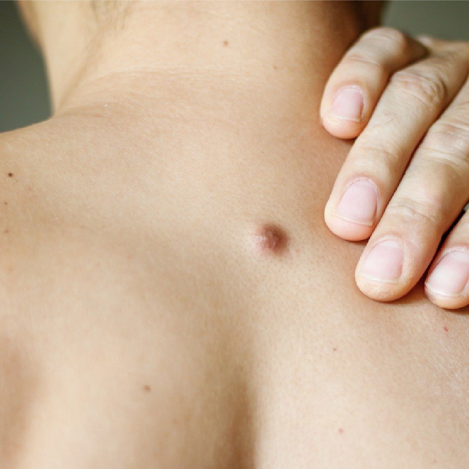 Facial Wart Laser Removal Before After - Single Session Results Ranchi