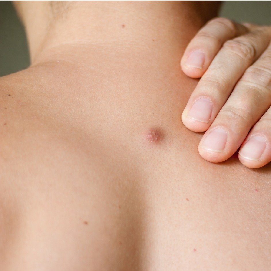 Raised Mole Surgical Excision Before After Results