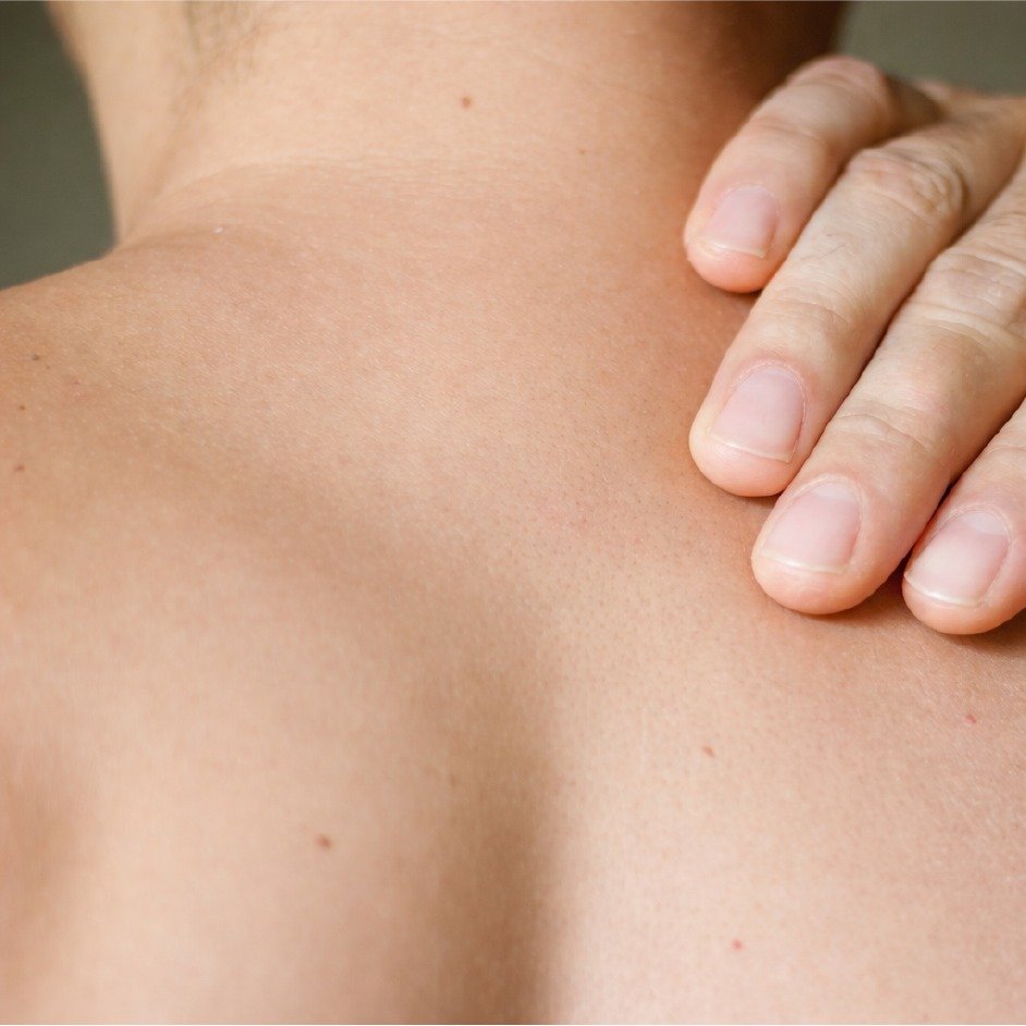 Sebaceous Cyst Complete Excision Before After