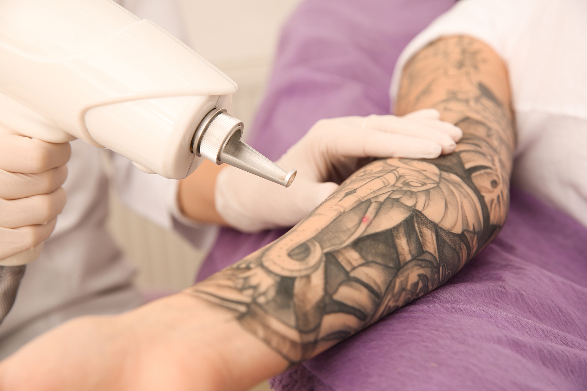 Tattoo Removal